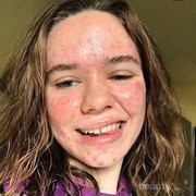 Muncul Bruntusan Setelah Mencoba Exfoliate Toner, Apa yang Salah?