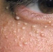 Muncul Bintik Putih di Bawah Mata? Berikut Cara Atasinya!