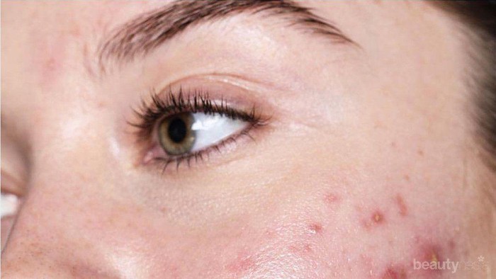 Mau Punya Wajah Bebas Jerawat? Cara Gampang Ini Bisa Kamu Lakuin!