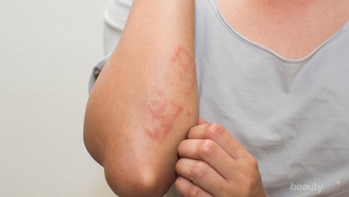 Wajib Simak, Tips Atasi Alergi Dingin dengan Bahan Alami