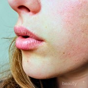 Wajah Gampang Bruntusan? Mungkin Ini Penyebabnya...