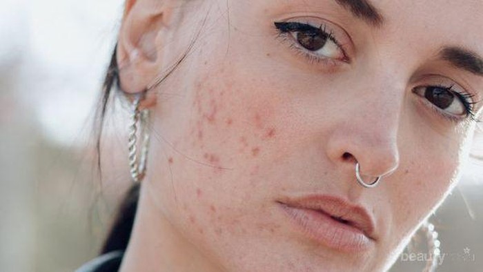 Wajah Berjerawat? Coba Deh Pakai Sabun Muka Ini!