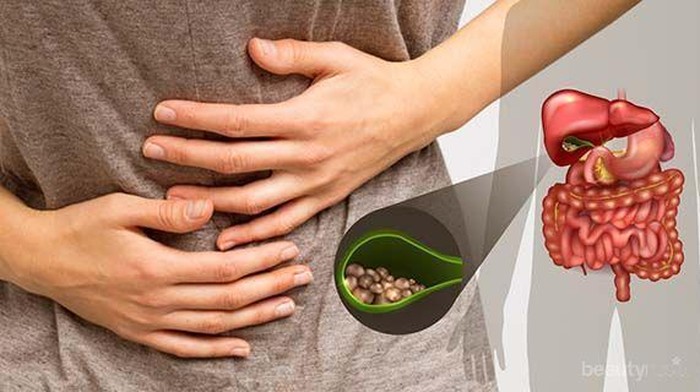 Jenis Batu Empedu yang Perlu Kamu Ketahui, Salah Satunya Mirip dengan Boba!