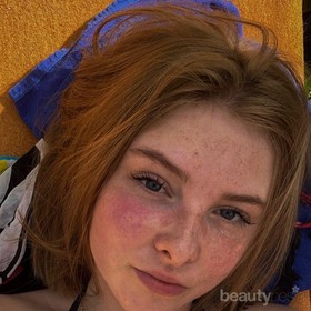 Sunburn Harus Segera Diatasi Biar Gak Makin Parah, Ini Dia 6 Trik Mengatasinya!
