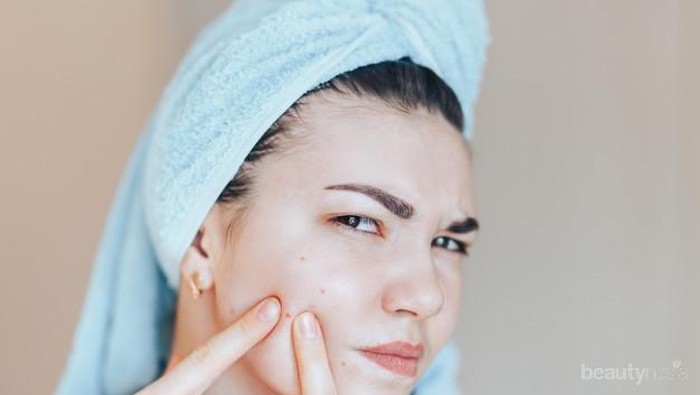 Jangan Sembarang! Jerawat di Bagian Wajah Ini Bahaya Kalau Dipencet