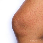 Mengenal Keratosis Pilaris, Jenis Penyakit Kulit yang Jarang Disadari