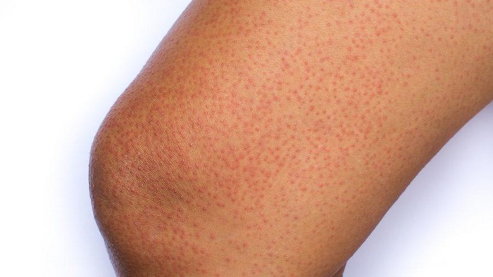 Mengenal Keratosis Pilaris, Jenis Penyakit Kulit yang Jarang Disadari