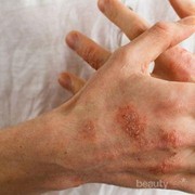 Musim Penghujan Bikin Kulit Mudah Biduran, Ini Cara Mencegahnya