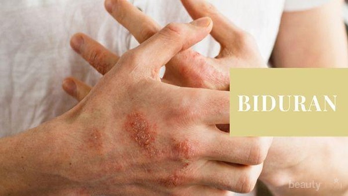 Musim Penghujan Bikin Kulit Mudah Biduran, Ini Cara Mencegahnya