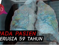 Ini Penampakan Paru-paru yang Terserang COVID-19