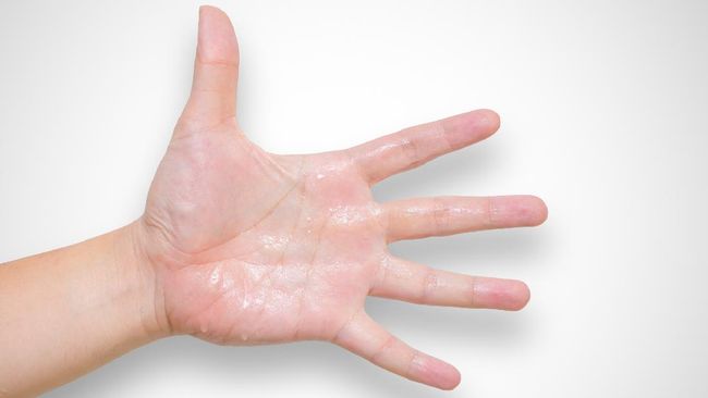 Produksi keringat yang berlebihan pada telapak tangan alias palmar hyperhydrosis perlu dikontrol agar tak menghambat aktivitas dan membuat Anda rendah diri.