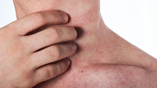 man scratching his neck with rash isolated on white