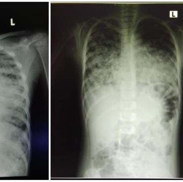 Urutan Risiko Kematian COVID-19, Ini Kelompok yang Paling Rentan