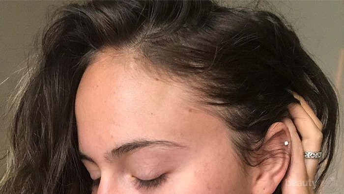 Ini 4 Tips Memilih Make Up Bagi Pemilik Kulit yang Rentan Berjerawat