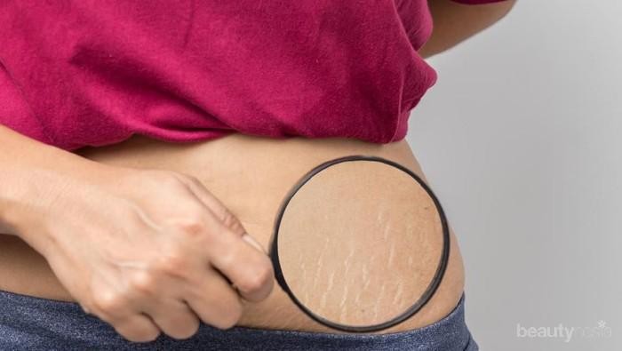 Dijamin Sempurna, Berikut Cara Menutupi Stretch Mark dengan Cepat!