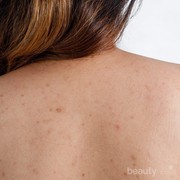 Jerawat Punggung Parah? Ini Dia Mengatasi Jerawat Punggung dengan Cepat dan Tepat