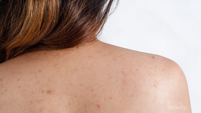 Jerawat Punggung Parah? Ini Dia Mengatasi Jerawat Punggung dengan Cepat dan Tepat