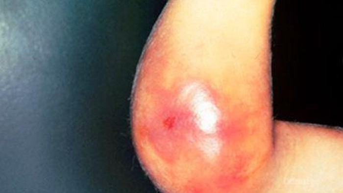 Penyakit Hemofilia, Kenali Jenis dan Penyebabnya!