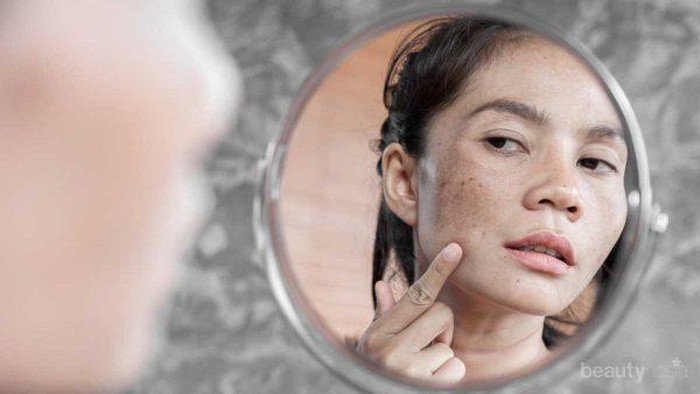 Sun Spot Atau Dark Spot? Kenali Perbedaannya, Yuk!