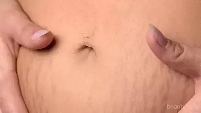 5 Cara Memudarkan Stretch Mark Di Rumah Dengan Mudah