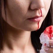 Ternyata ini 5 Penyebab Kamu Sering Mimisan! Jangan Lupa Dicatat Ya Ladies!