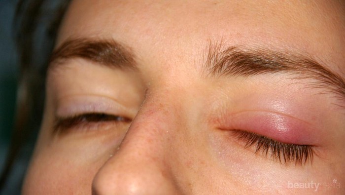 Apa Itu Kalazion? Apa Saja Penyebab dan Gejalanya?