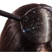 Cara Alami Menghilangkan Ketombe Parah dalam Waktu Singkat