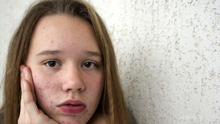 Ingin Hilangkan Bruntusan? Coba 5 Tips Skincare Berikut Ini Deh!