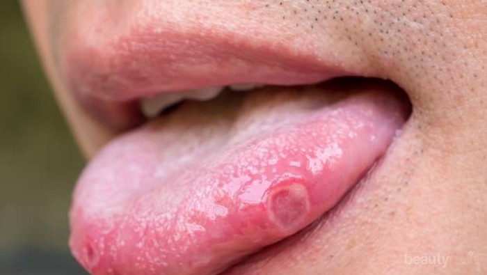 Cara Mengobati Sariawan Secara Alami Tanpa Rasa Perih!