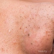 4 Teknik Menghilangkan Komedo Berikut Salah Kaprah, Jangan Lakukan!