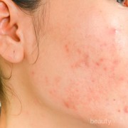 Purging VS Breaking Out, Ini yang Harus Kamu Tahu!