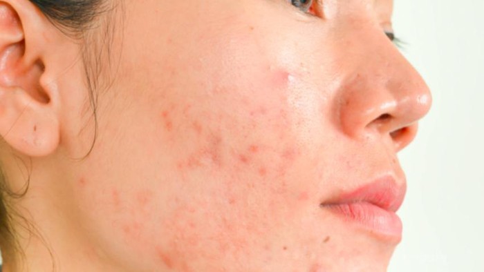 Purging VS Breaking Out, Ini yang Harus Kamu Tahu!