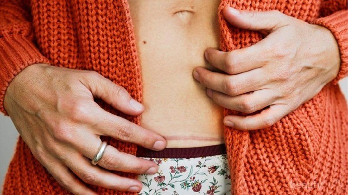 4 Pertimbangan Berikut Harus Kamu Pikirkan Sebelum Sedot Lemak, Jangan Gegabah!