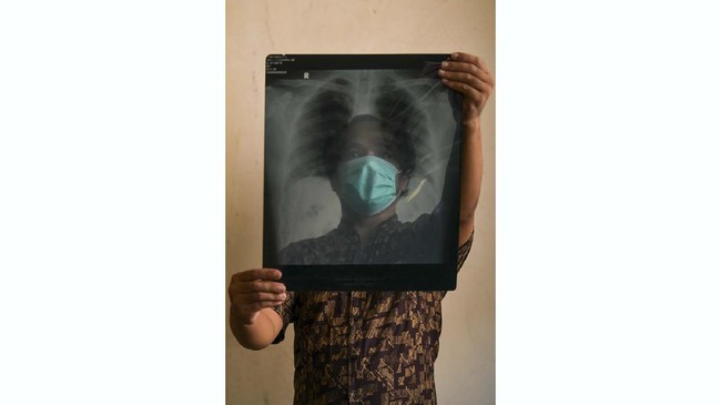 Ara Wiraswara (39), seorang ASN, menunjukkan hasil rontgen paru-paru miliknya di Bogor. Dari pengalaman Ara selama menjalani isolasi di RSUD Kota Bogor, Jawa Barat, dukungan moral sangat dibutuhkan oleh pasien.