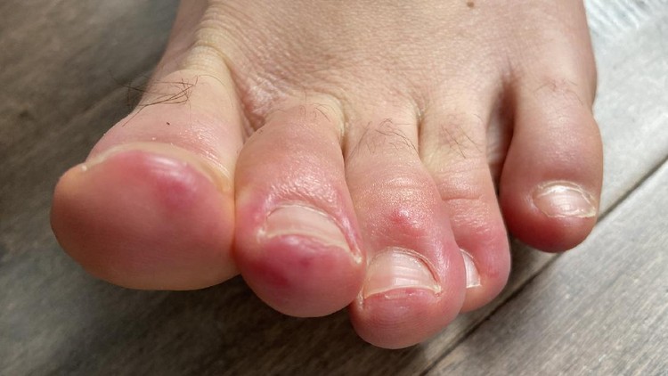 Covid toes atau ruam pada kaki pasien corona