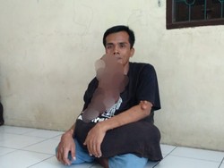 Sakit Misterius, Wajah Pria Medan Seperti Meleleh-Tubuhnya Penuh Benjolan