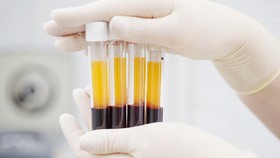 Yang Harus Diketahui Soal Terapi Plasma Darah Convalescent