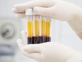 Plasma Darah Bisa Bantu Mengukur Keparahan Pasien Covid-19