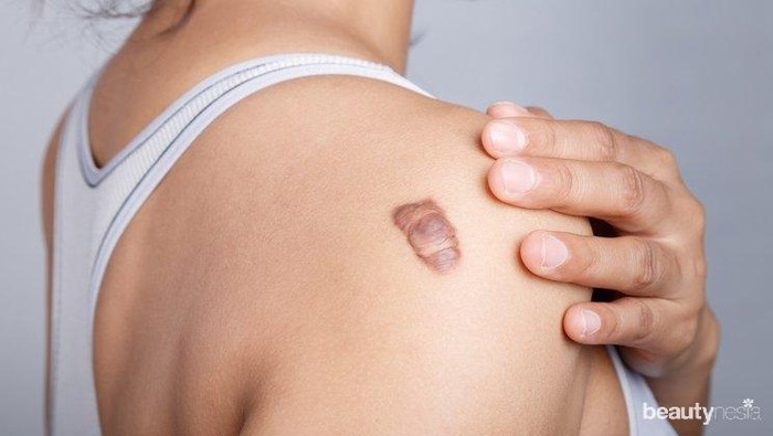 Keloid Bikin Gak Pede? Atasi dengan 5 Bahan Alami Ini!