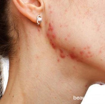 img-title Bikin Jerawatan, Ini Dia Tips Pakai Masker Agar Kulit Tetap Sehat Terjaga
