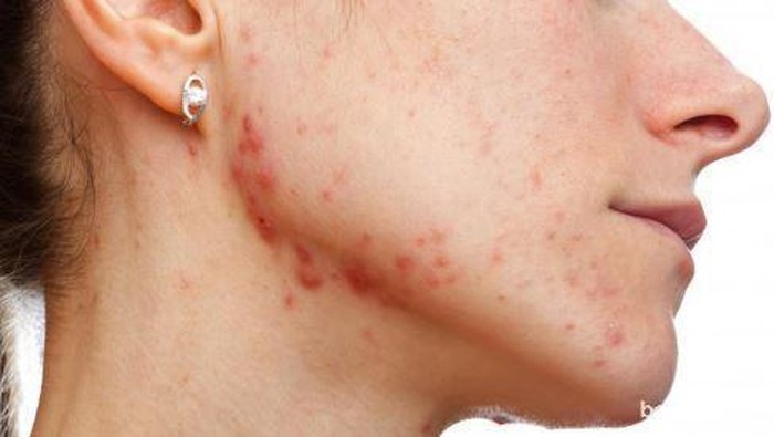 Bikin Jerawatan, Ini Dia Tips Pakai Masker Agar Kulit Tetap Sehat Terjaga Bikin Jerawatan, Ini Dia Tips Pakai Masker Agar Kulit Tetap Sehat Terjaga