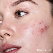 Lawan Jerawat Nakal dengan Lima Pilihan Produk Acne Spot Ini!