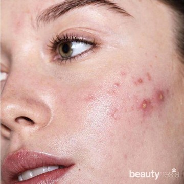 img-title Lawan Jerawat Nakal dengan Lima Pilihan Produk Acne Spot Ini!