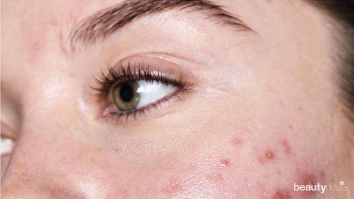 Lawan Jerawat Nakal dengan Lima Pilihan Produk Acne Spot Ini! Lawan Jerawat Nakal dengan Lima Pilihan Produk Acne Spot Ini!