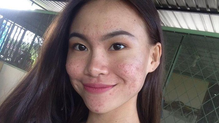 5 Rekomendasi Pembersih Wajah Remaja Ampuh untuk Kulit Berjerawat 5 Rekomendasi Pembersih Wajah Remaja Ampuh untuk Kulit Berjerawat