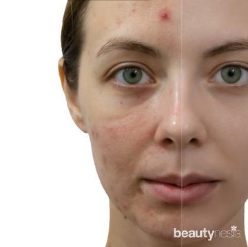img-title Menghilangkan Acne Scars Gak Boleh Sembarangan, Ini yang Harus Kamu Perhatikan!