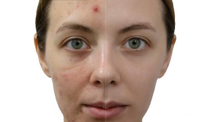 Menghilangkan Acne Scars Gak Boleh Sembarangan, Ini yang Harus Kamu Perhatikan!