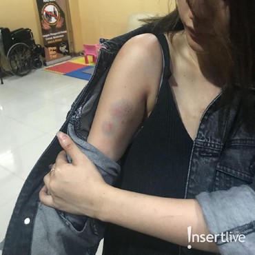 5 Foto Tubuh Memar dan Berdarah Aska Ongi Korban KDRT Aliff Alli