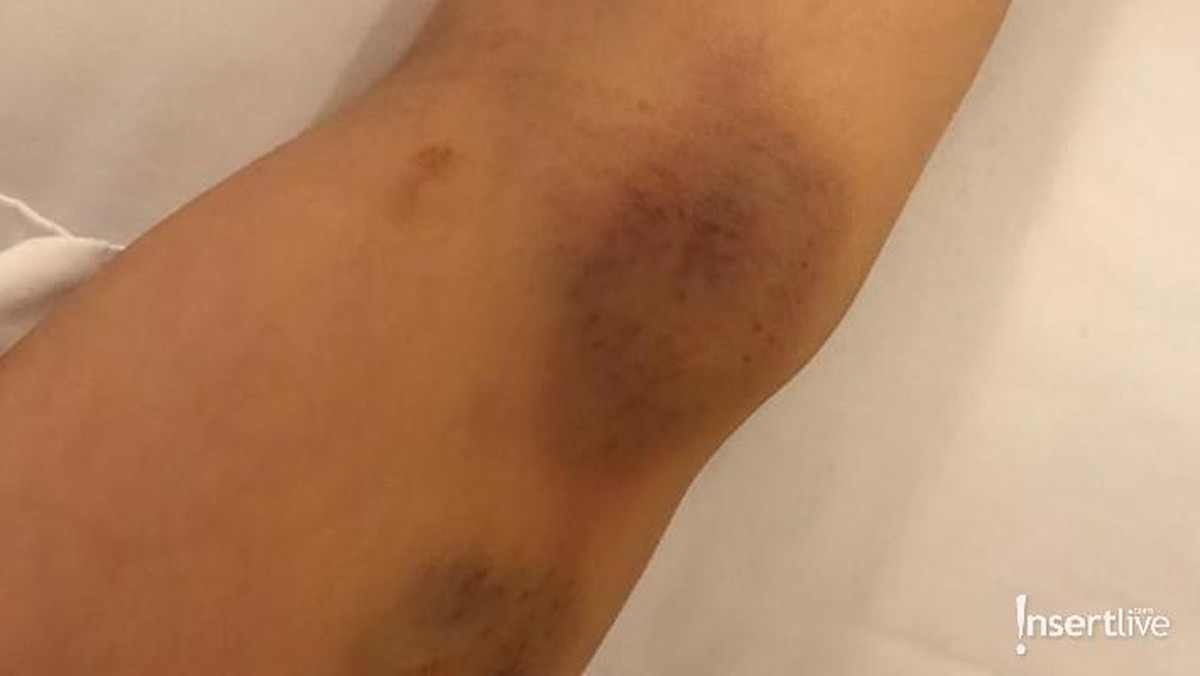 Foto Bukti KDRT Aska Ongi