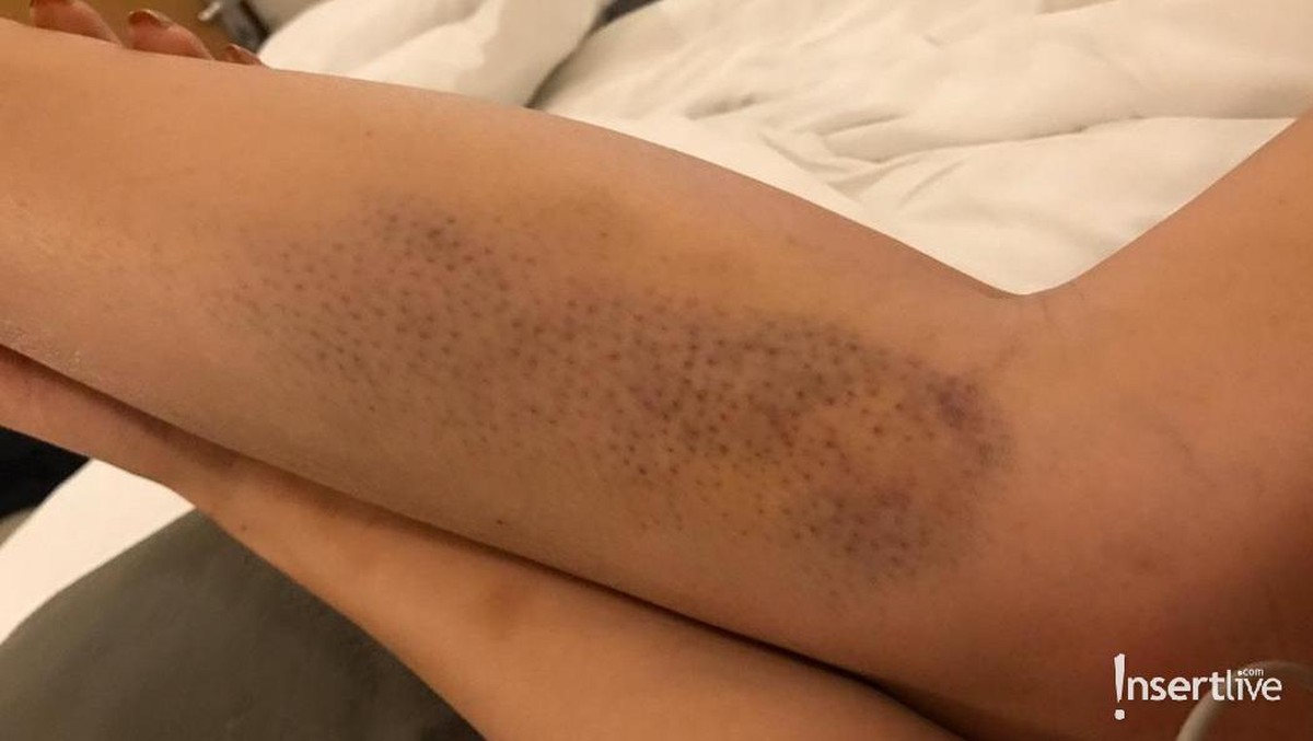 Foto Bukti KDRT Aska Ongi